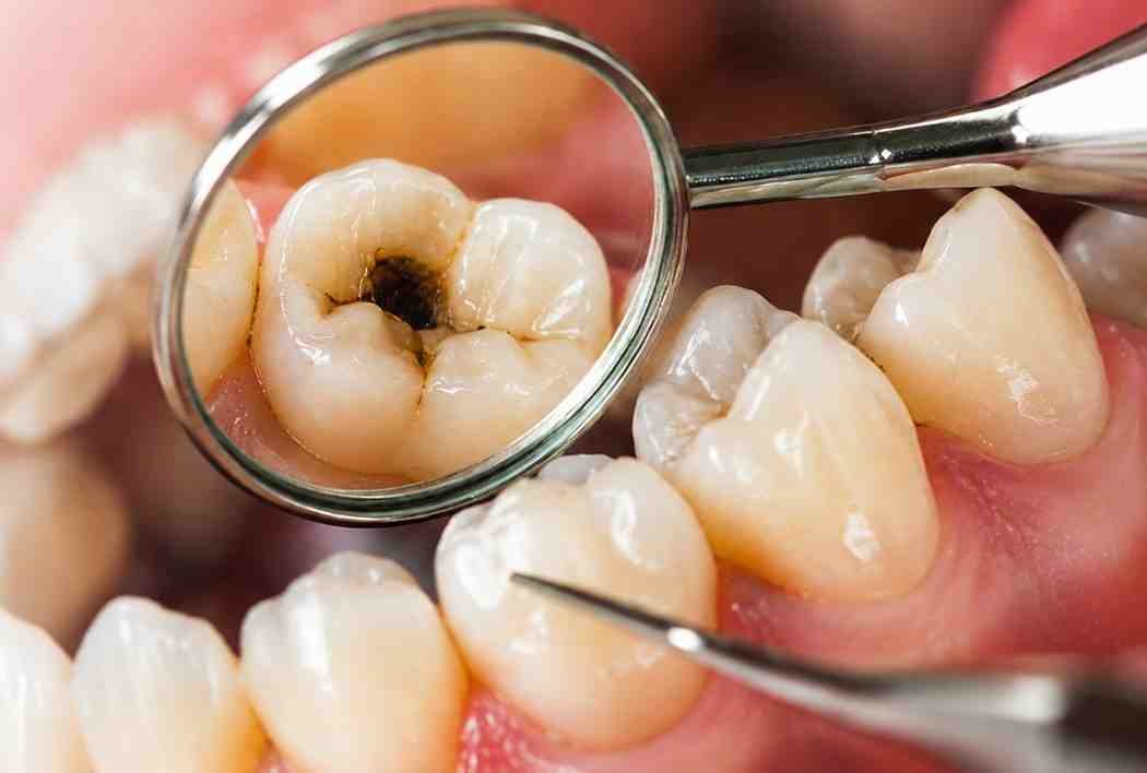Cavity Filling